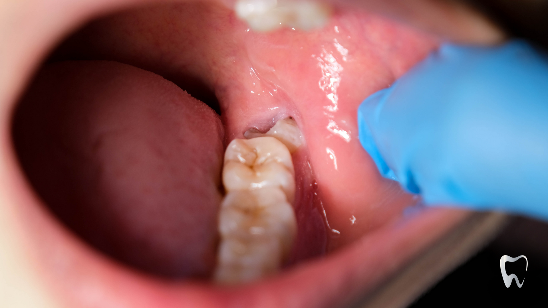 A close up of a person 's mouth with a tooth missing.