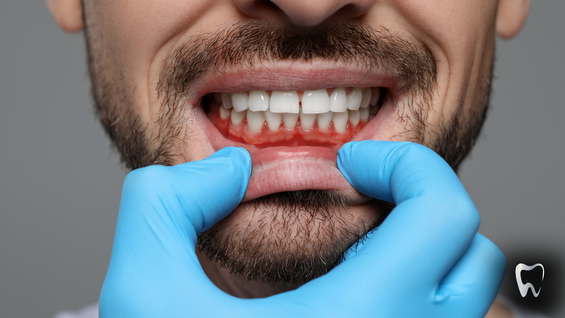 A man with a beard is getting his teeth examined by a dentist.