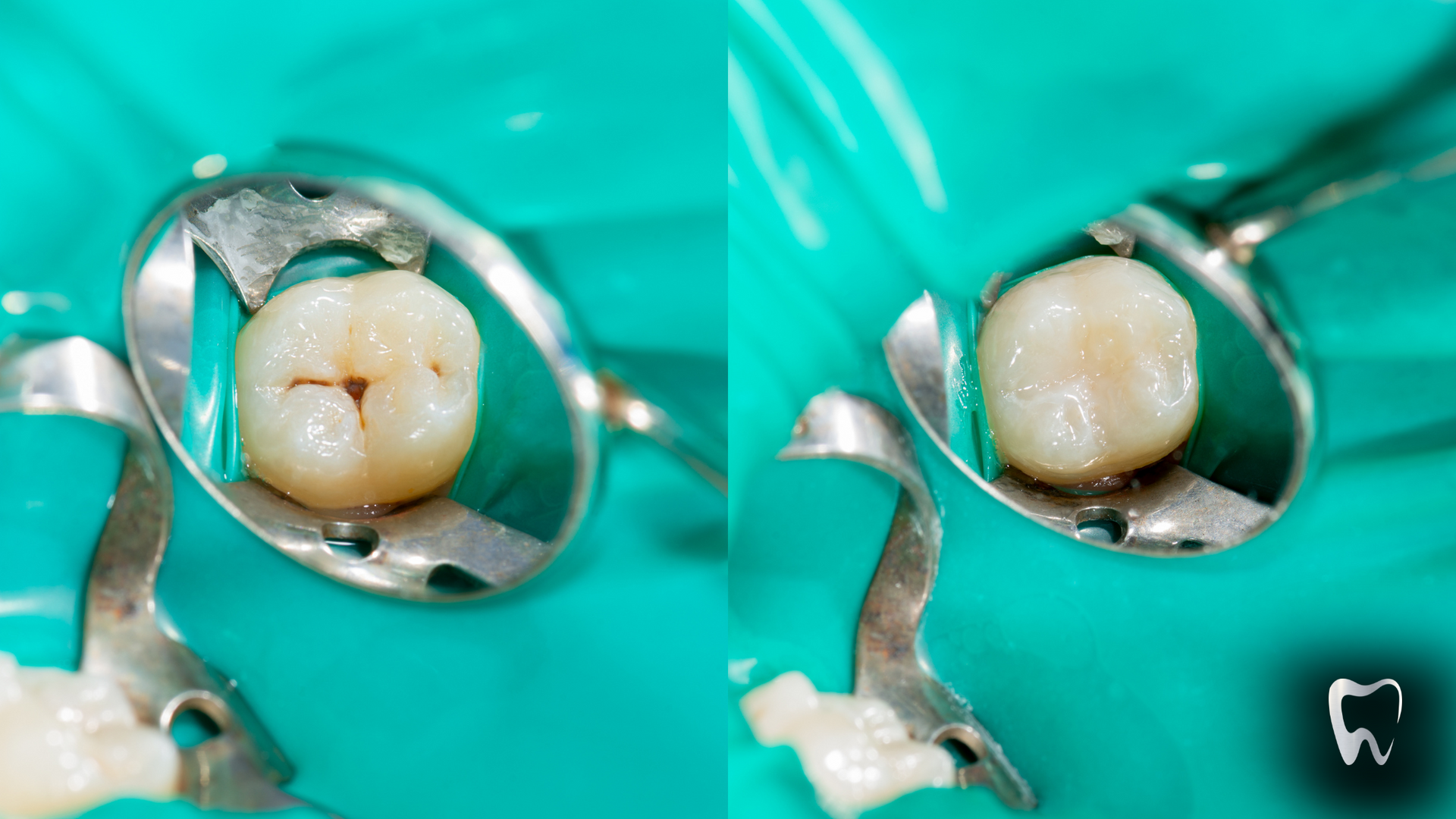 A tooth with a hole in it is being examined by a dentist.