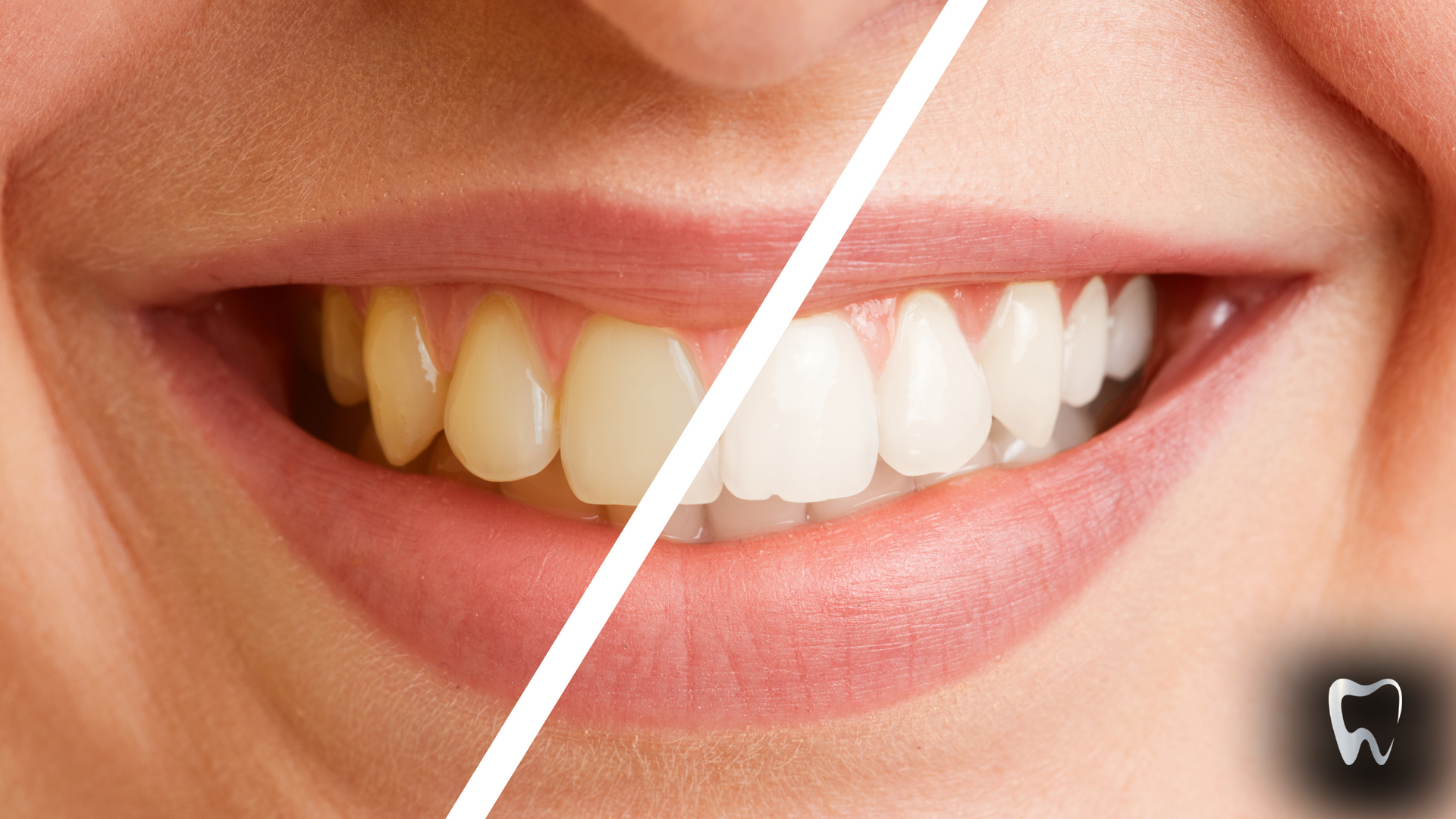 A close up of a woman 's teeth before and after whitening.