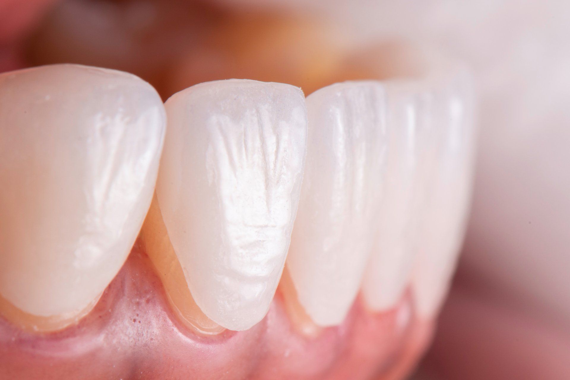 A close up of a person 's teeth and gums.