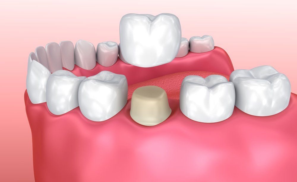 A computer generated image of a dental crown being placed on a tooth.