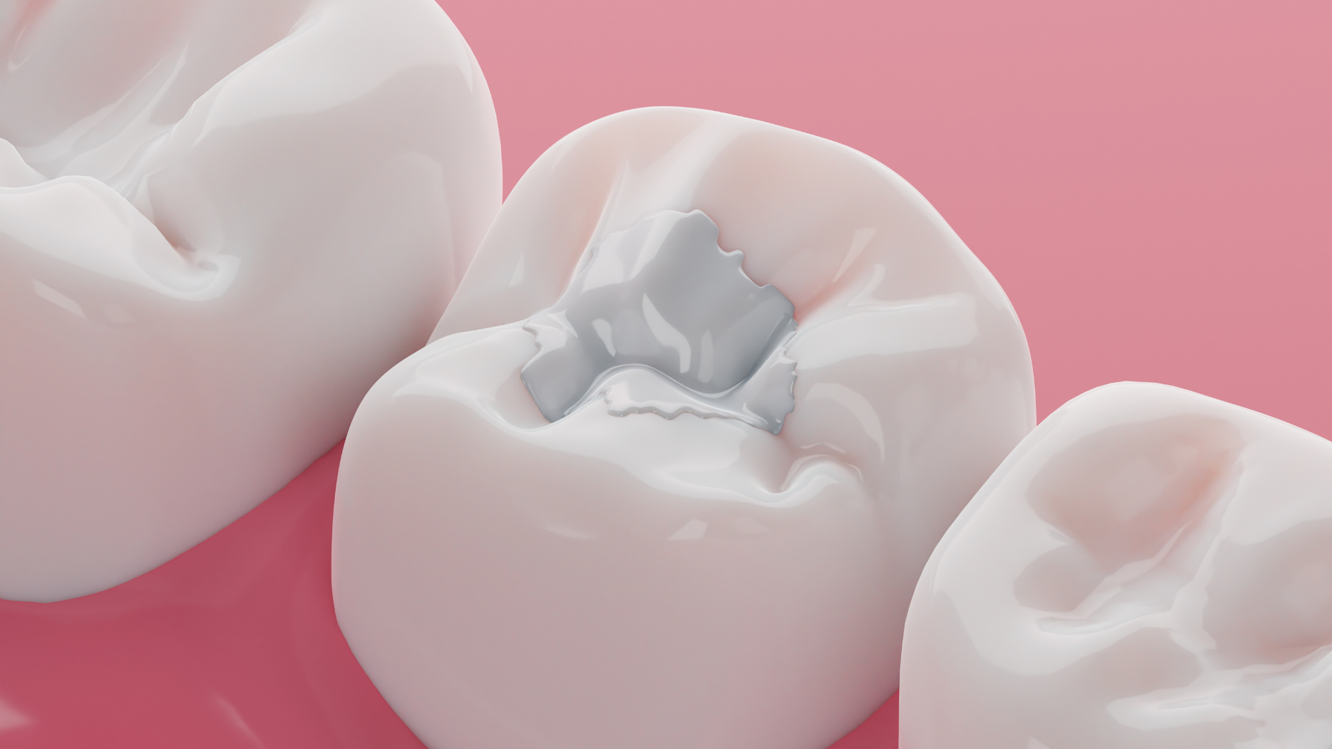 A close up of three white teeth with a filling in them on a pink surface.