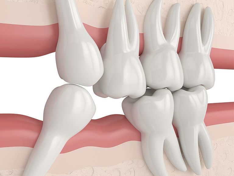 A close up of a row of teeth in a mouth.