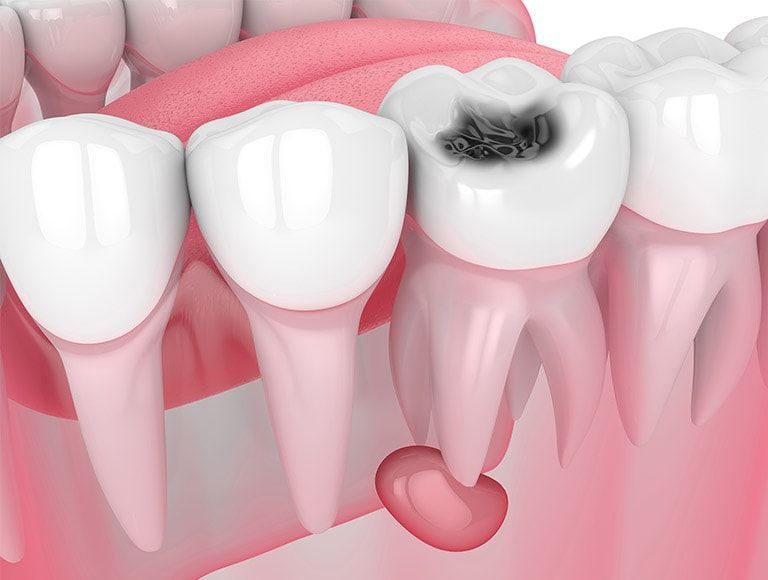 A close up of a tooth with a hole in it.