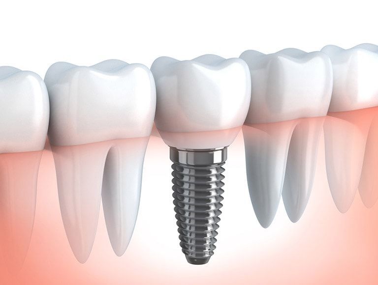 A close up of a dental implant in a row of teeth.