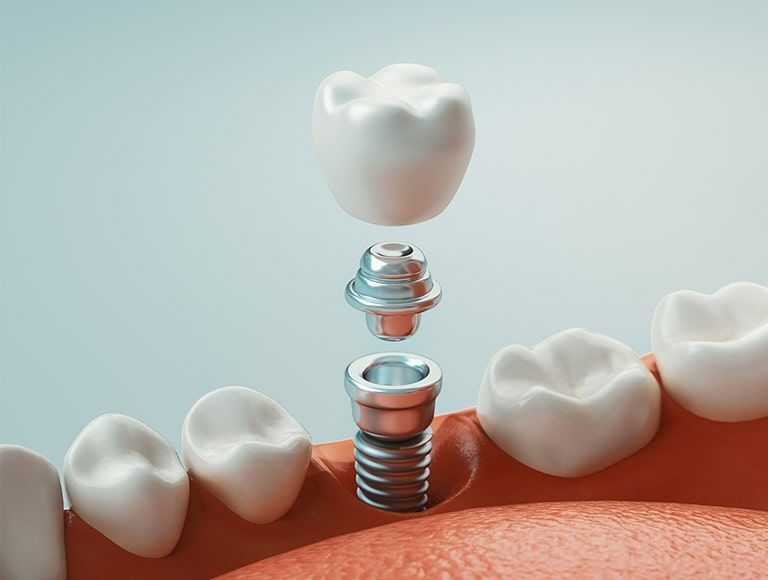 A close up of a dental implant in a person 's mouth.