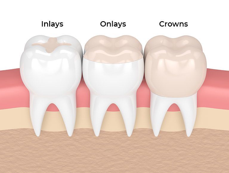 There are three different types of tooth fillings , inlays , onlays , and crowns.