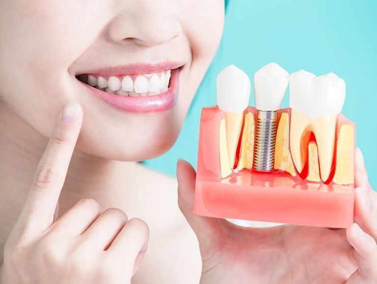 A woman is holding a model of a dental implant in her hand.