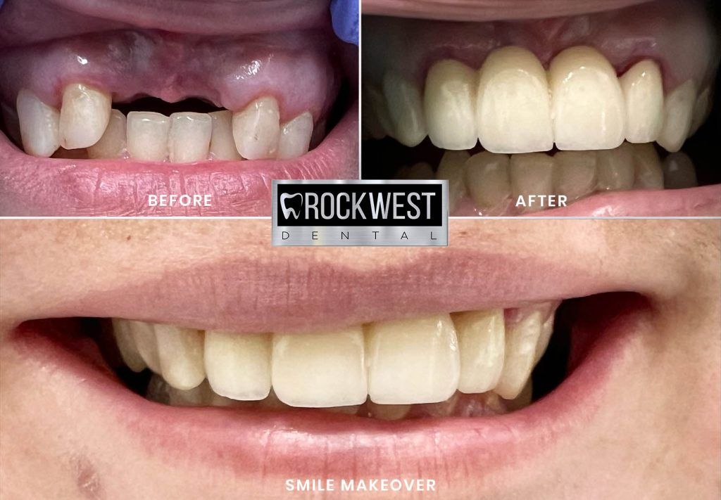 A before and after photo of a person 's teeth.