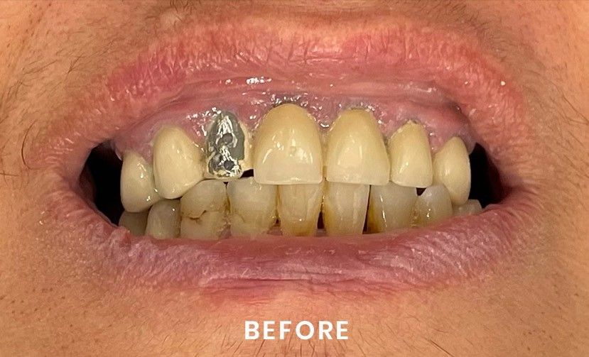 A close up of a person 's teeth before a dental treatment.