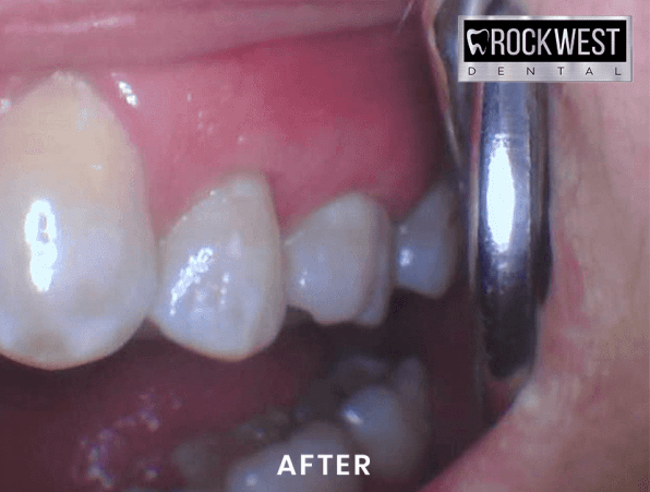 A close up of a person 's teeth with rockwest dental in the corner