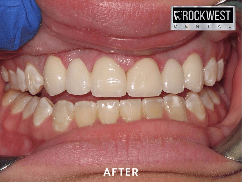 A close up of a person 's teeth with rockwest dental in the background