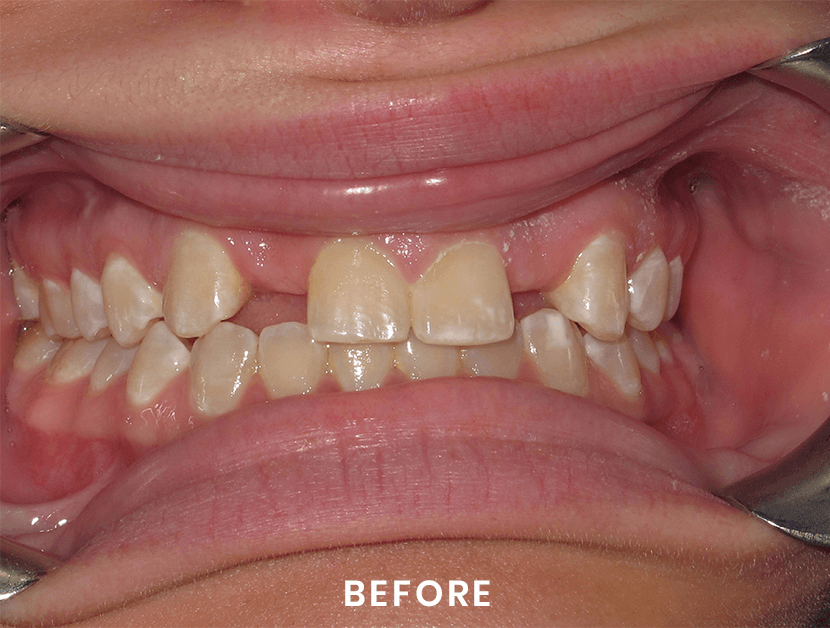 A close up of a person 's teeth before a dental treatment.