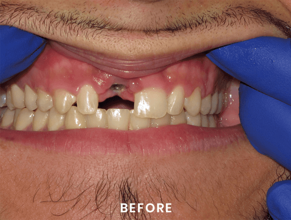 A close up of a man 's mouth with a missing tooth.