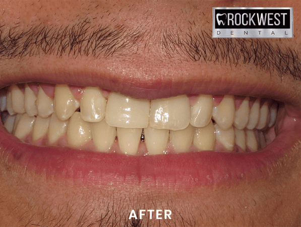 A close up of a man 's teeth with rockwest dental in the background