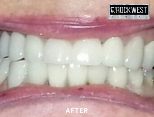 A close up of a person 's teeth with a rockwest logo in the background