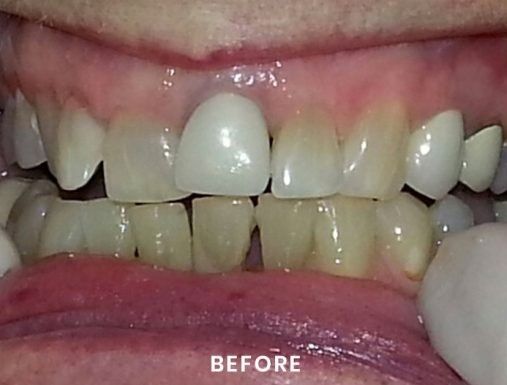 A close up of a person 's teeth before a dental treatment.