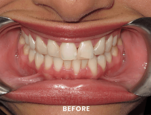 A close up of a person 's mouth with a dental mirror.