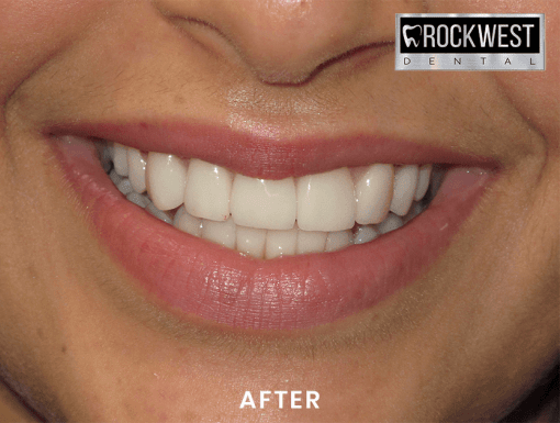 A close up of a woman 's mouth with white teeth and red lips.