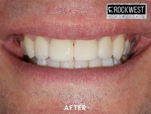 A close up of a man 's teeth with rockwest dental in the background