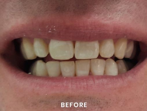 A close up of a person 's teeth with the words before written on the bottom.