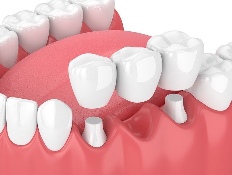 A 3d rendering of a dental bridge in a person 's mouth.