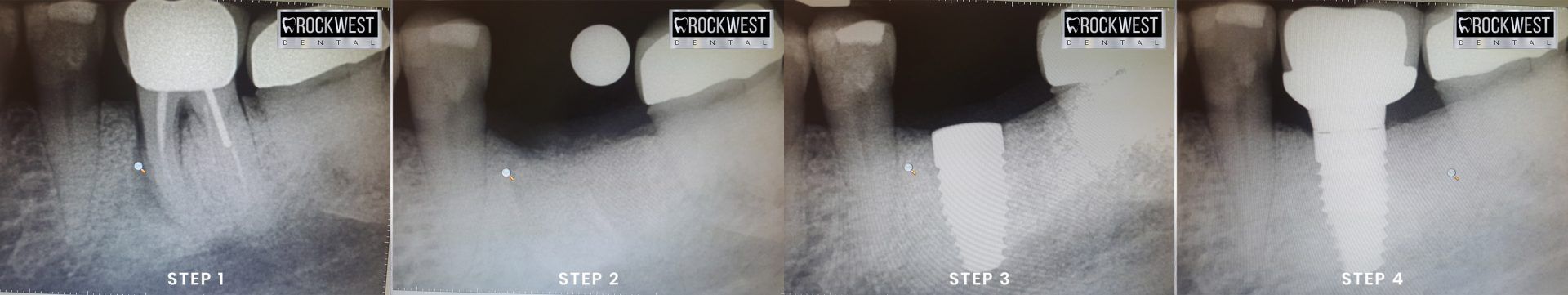 Four x-rays of a tooth are shown in a row