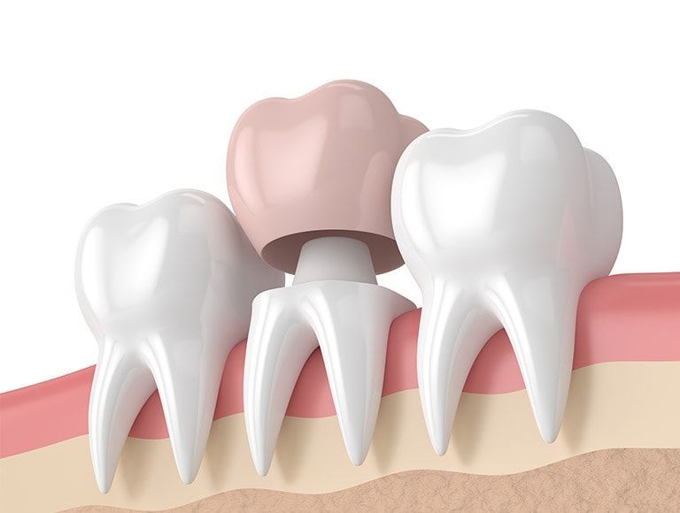 A group of teeth with a dental crown on top of them.