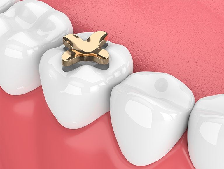 A close up of a tooth with a gold filling in it