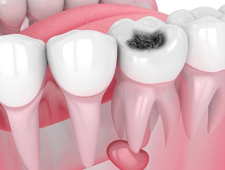 A close up of a tooth with a hole in it and a heart sticking out of it.