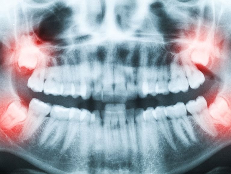 An x-ray of a person 's teeth with red spots on them.