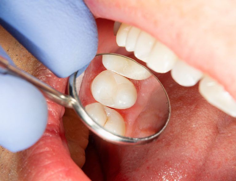 A dentist is examining a person 's teeth with a mirror.