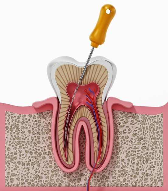 A tooth with a screwdriver sticking out of it