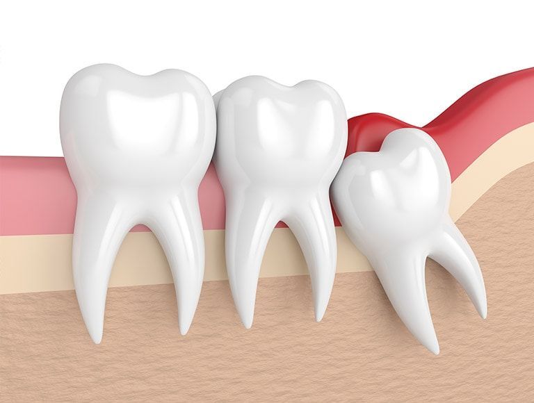 A 3d rendering of a row of teeth with wisdom teeth growing out of them.