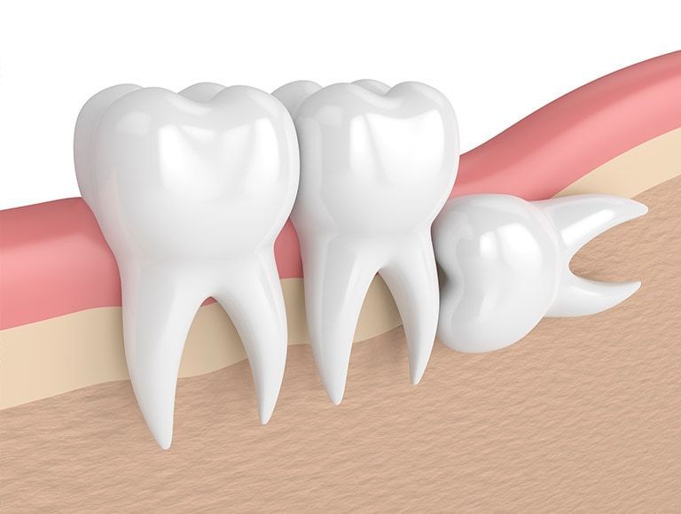 A 3d rendering of a tooth with a wisdom tooth growing out of it.