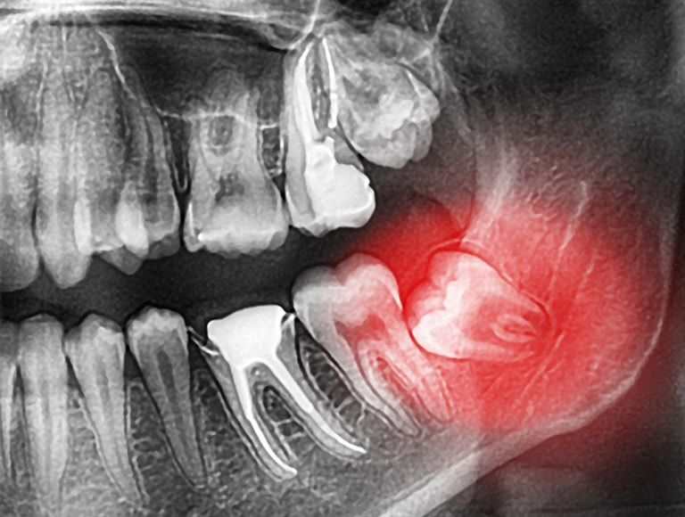 An x-ray of a person 's teeth with a large wisdom tooth.