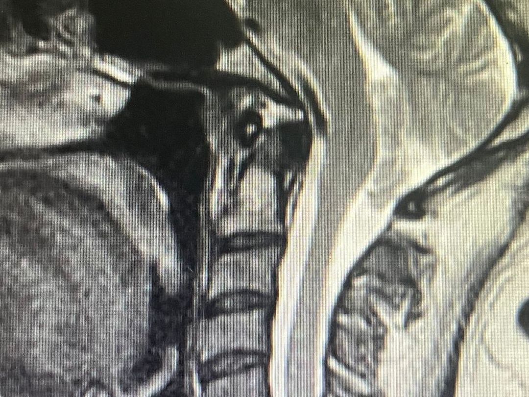 Cirurgia para malformação de Chiari em são luís