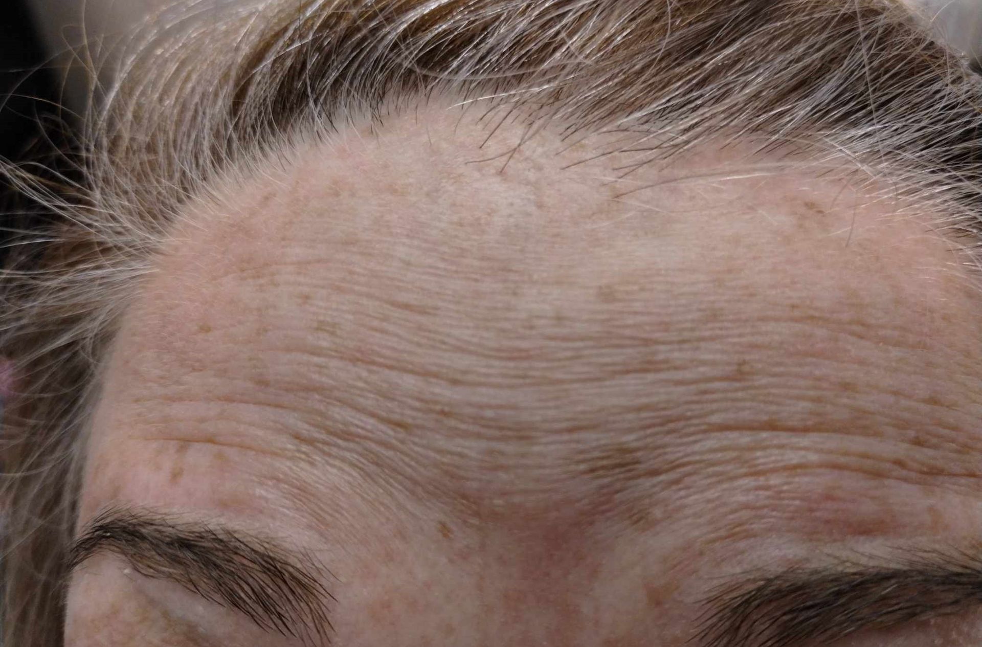 A close up of a woman 's forehead with wrinkles and hair.