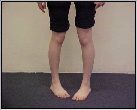Child Toe - Perth, WA - Centrepod Podiatry
