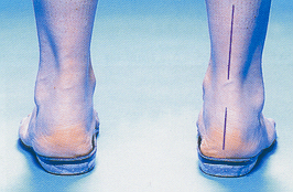 Flat Foot Orthotics - Perth, WA - Centrepod Podiatry