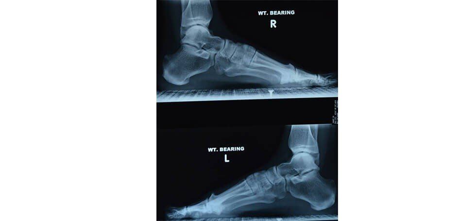Foot X-Ray - Perth, WA - Centrepod Podiatry