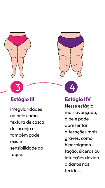 Um desenho das pernas de uma mulher mostrando os estágios 3 e 4