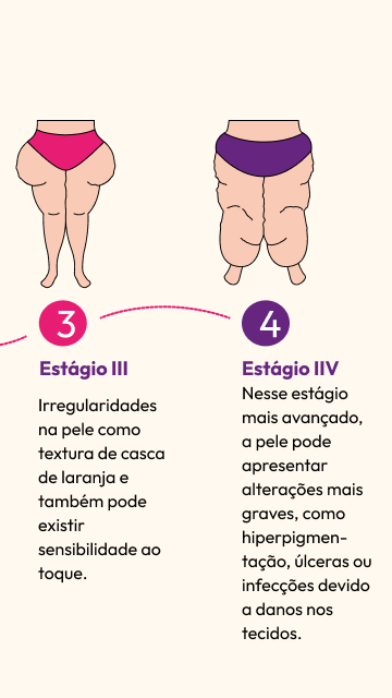 Um desenho das pernas de uma mulher com os números 3 e 4 nelas