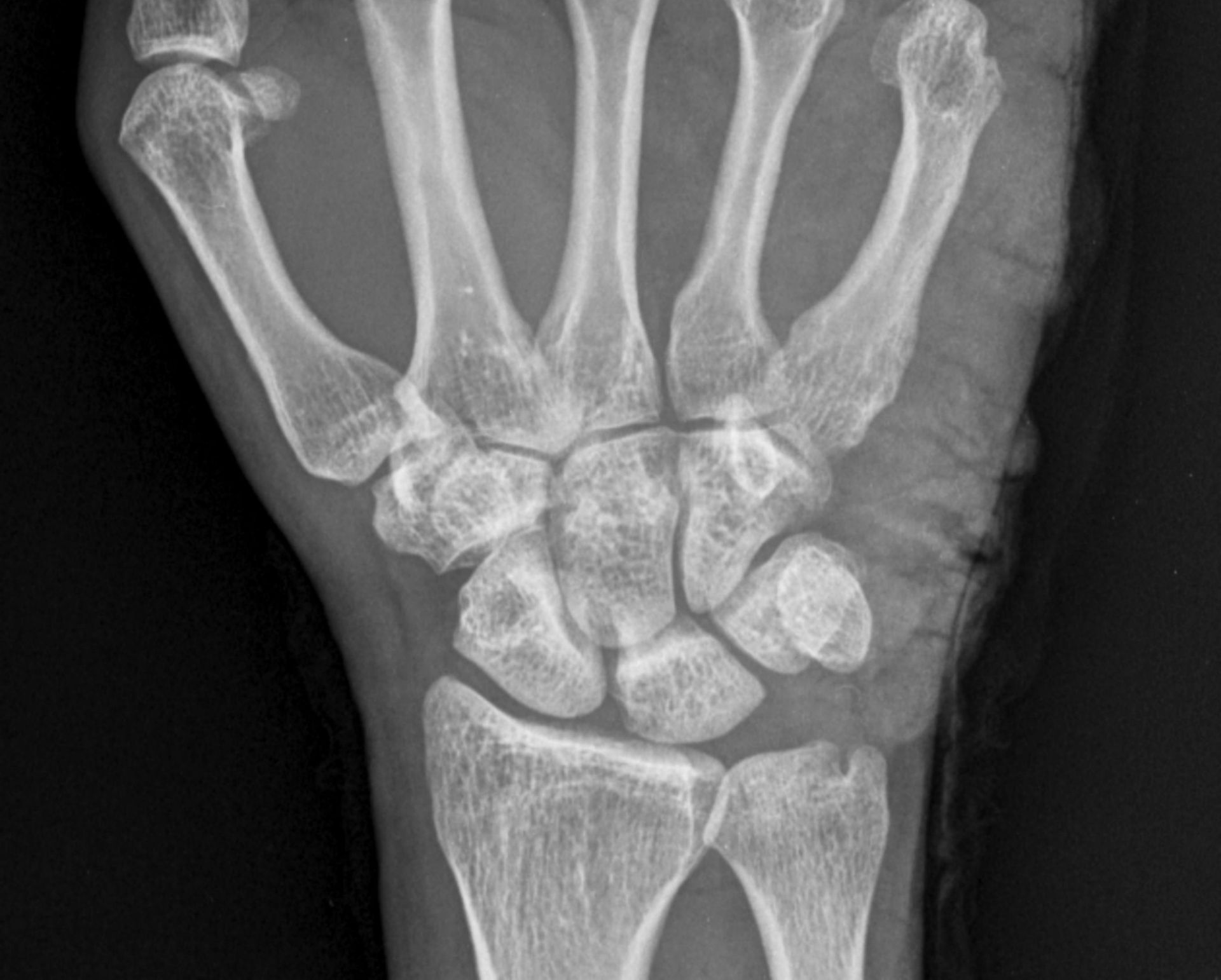 X-ray of a human wrist, showing bones of the hand, wrist, and forearm.
