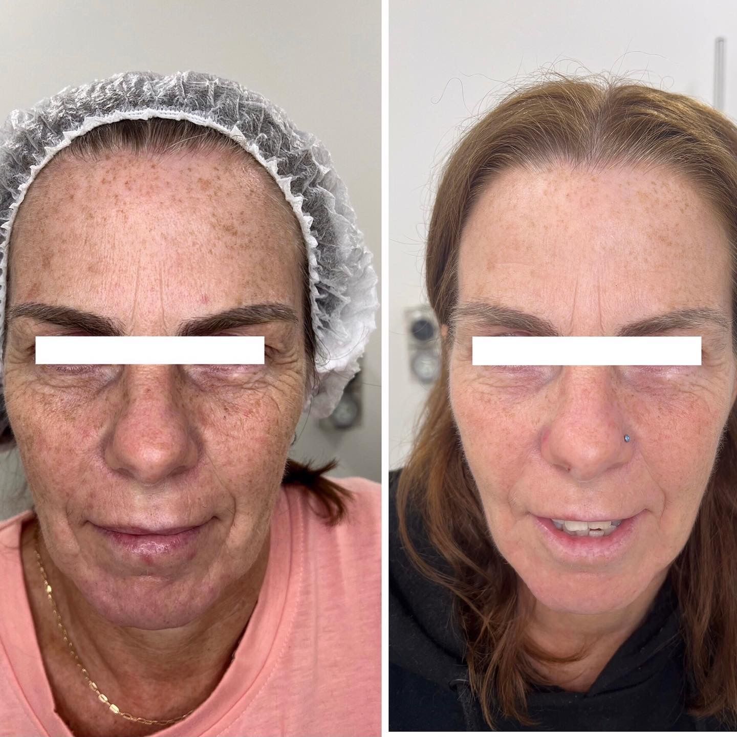 A before and after photo of a woman 's face.