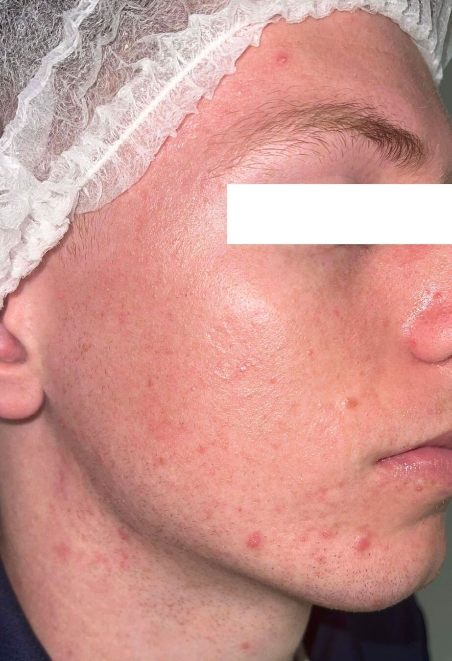 A close up of a man 's face with acne and a white hat on.
