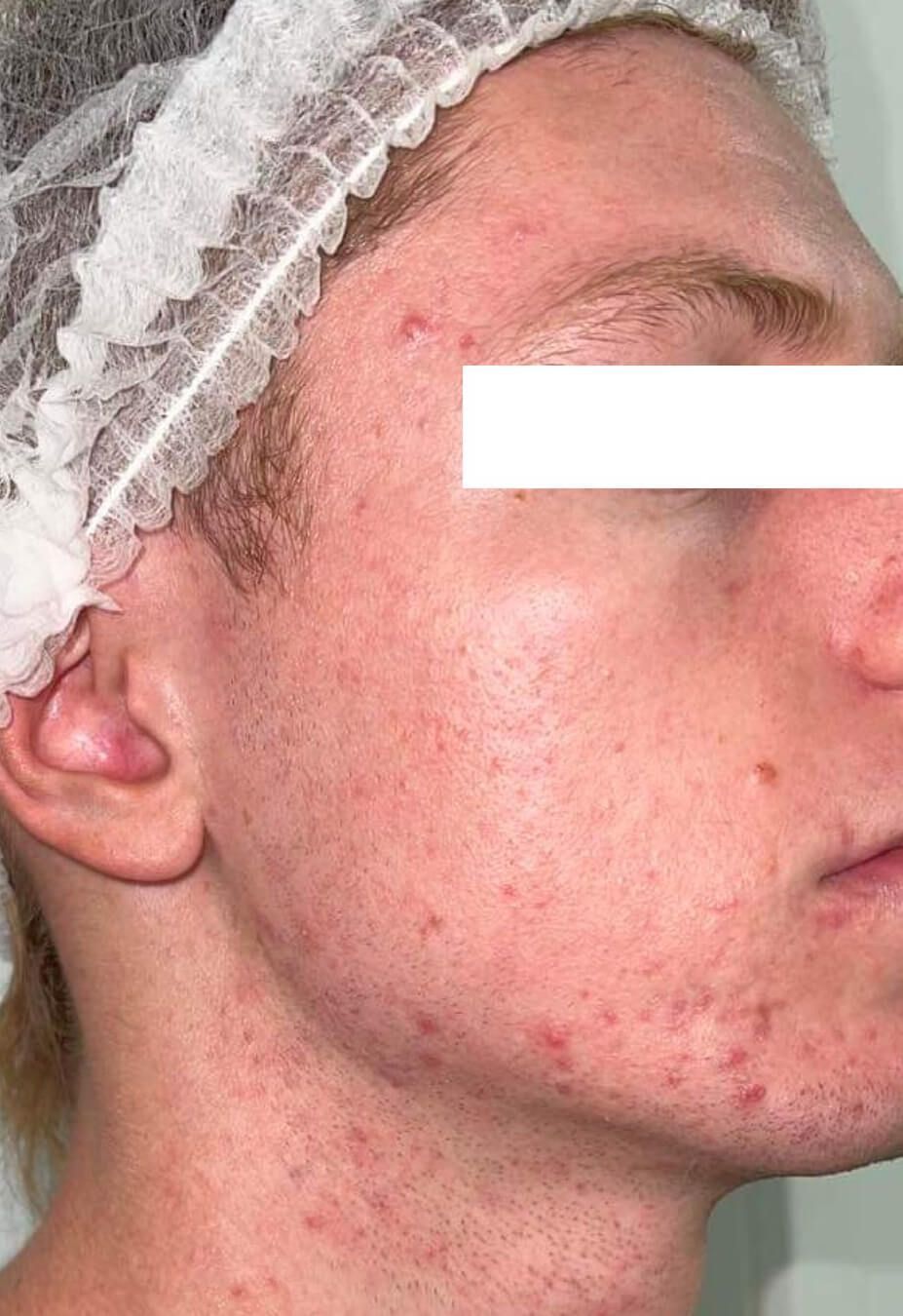 A man with acne on his face is wearing a white headband.