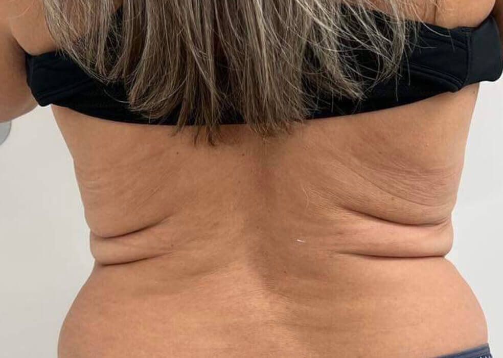 The back of a woman in a black bra is shown.