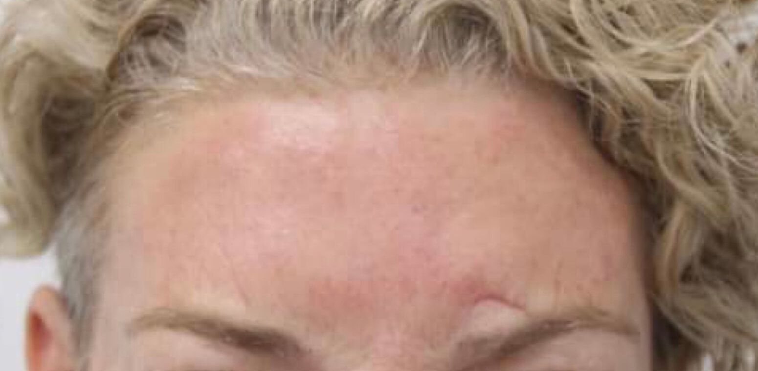 A close up of a woman 's forehead with a red spot on it.